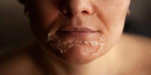facial peeling